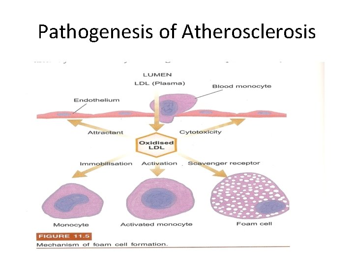 Pathogenesis of Atherosclerosis 