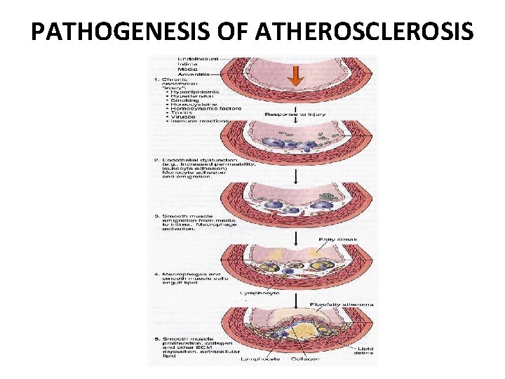 PATHOGENESIS OF ATHEROSCLEROSIS 