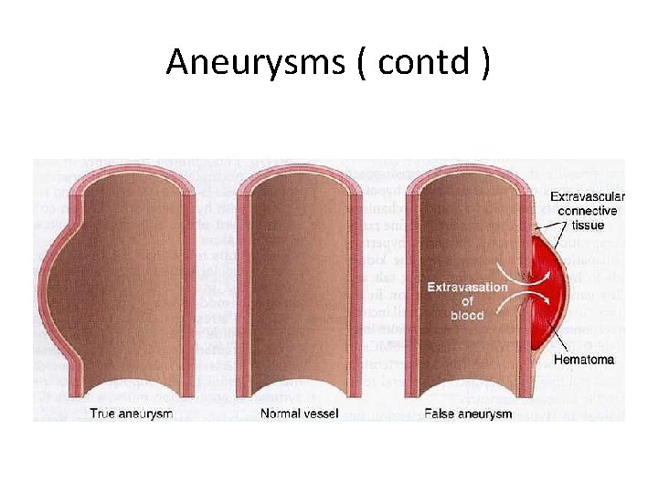 Aneurysms ( contd ) 