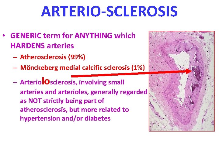 ARTERIO-SCLEROSIS • GENERIC term for ANYTHING which HARDENS arteries – Atherosclerosis (99%) – Mönckeberg