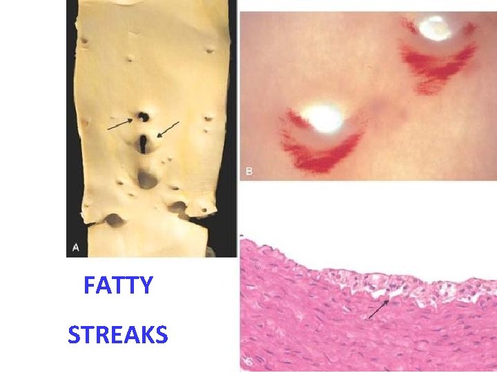 FATTY STREAKS 