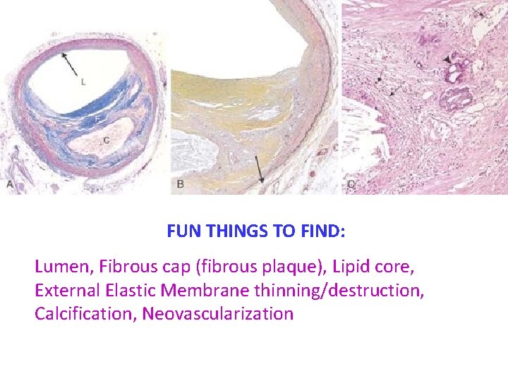 FUN THINGS TO FIND: Lumen, Fibrous cap (fibrous plaque), Lipid core, External Elastic Membrane