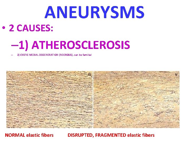 ANEURYSMS • 2 CAUSES: – 1) ATHEROSCLEROSIS – 2) CYSTIC MEDIAL DEGENERATION (NECROSIS), can