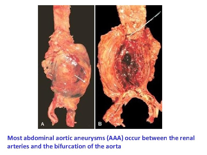 Most abdominal aortic aneurysms (AAA) occur between the renal arteries and the bifurcation of
