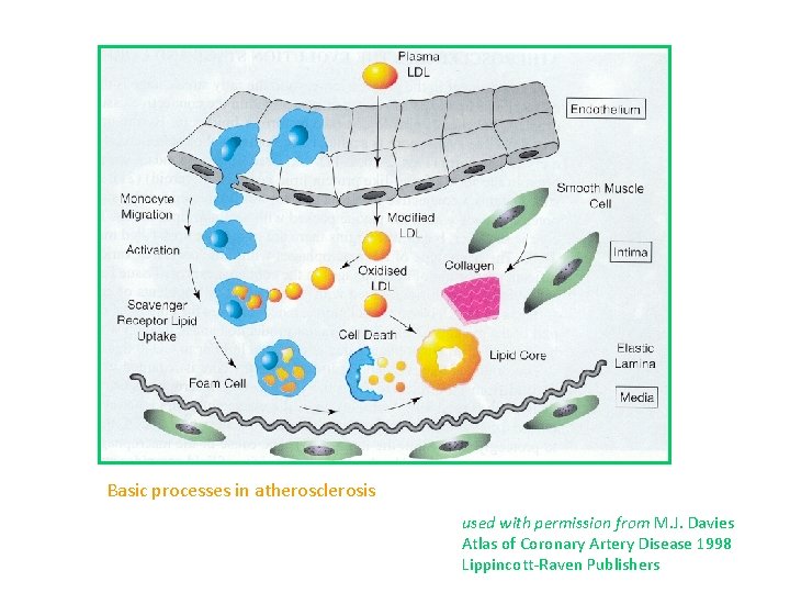 Basic processes in atherosclerosis used with permission from M. J. Davies Atlas of Coronary