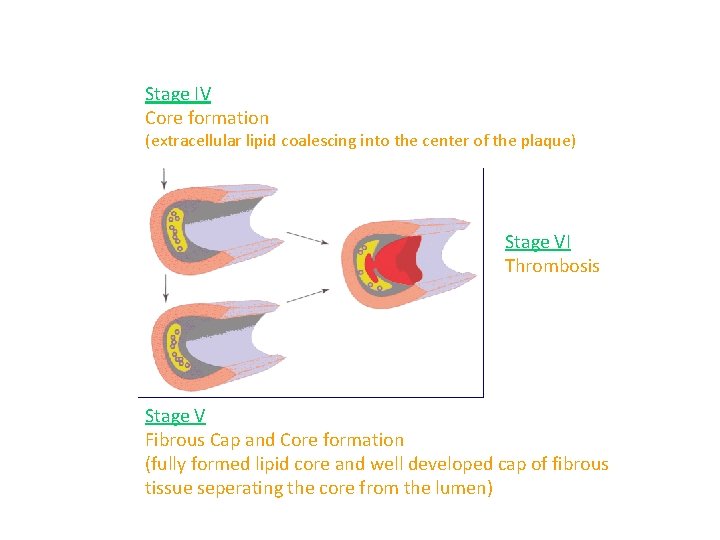 Stage IV Core formation (extracellular lipid coalescing into the center of the plaque) Stage