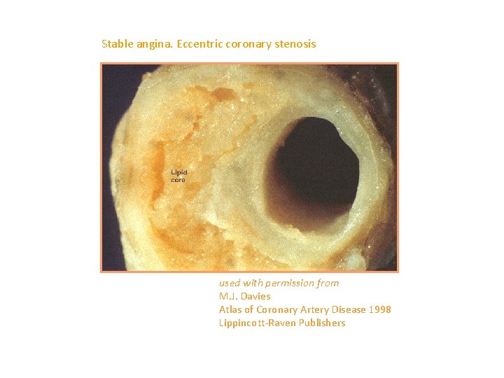 Stable angina. Eccentric coronary stenosis used with permission from M. J. Davies Atlas of