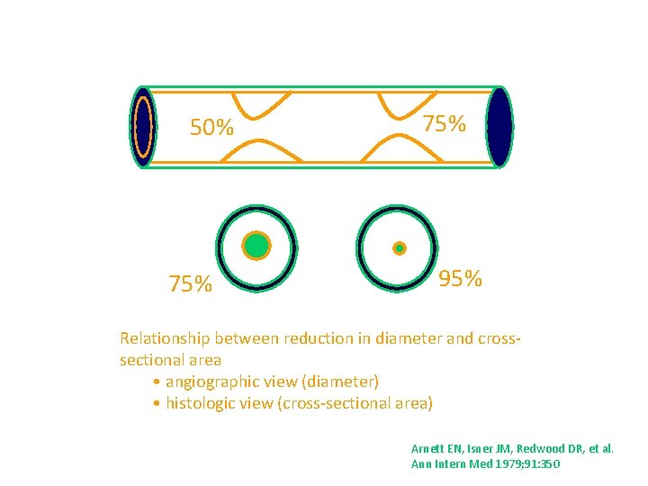 50% 75% 95% Relationship between reduction in diameter and crosssectional area • angiographic view