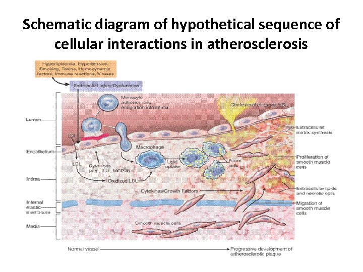 Schematic diagram of hypothetical sequence of cellular interactions in atherosclerosis 