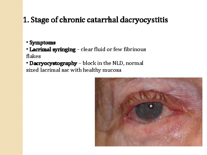 1. Stage of chronic catarrhal dacryocystitis • Symptoms • Lacrimal syringing – clear fluid