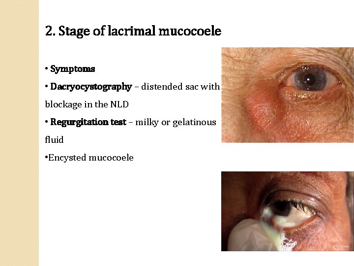 2. Stage of lacrimal mucocoele • Symptoms • Dacryocystography – distended sac with blockage