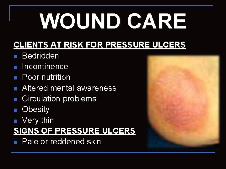 WOUND CARE CLIENTS AT RISK FOR PRESSURE ULCERS n Bedridden n Incontinence n Poor