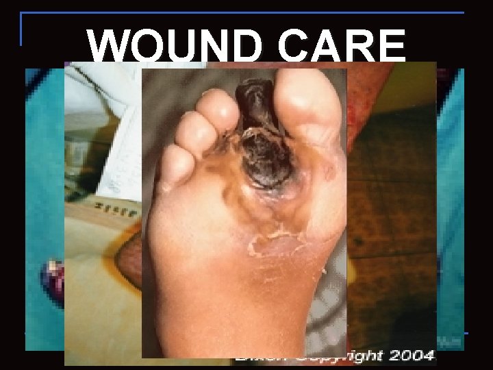 WOUND CARE 