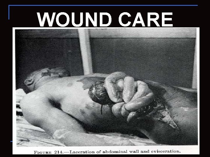 WOUND CARE 