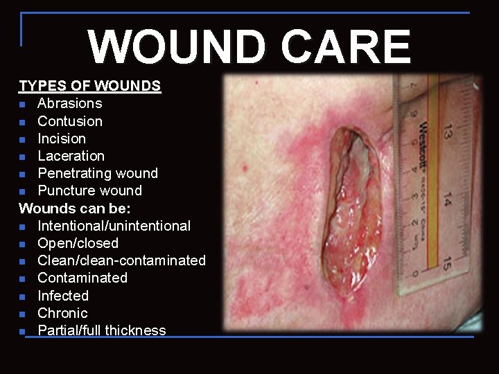 WOUND CARE TYPES OF WOUNDS n Abrasions n Contusion n Incision n Laceration n