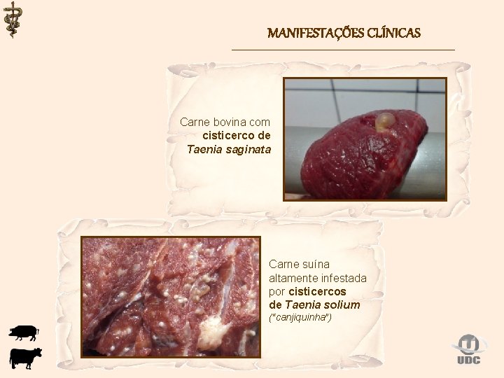 MANIFESTAÇÕES CLÍNICAS Carne bovina com cisticerco de Taenia saginata Carne suína altamente infestada por