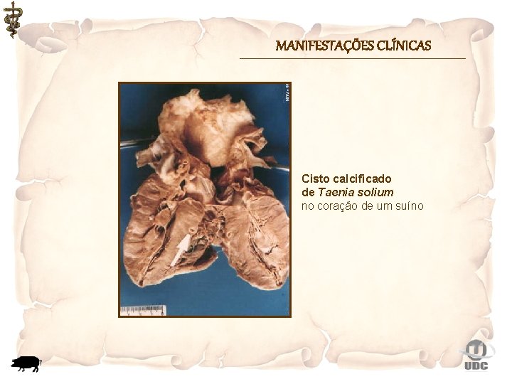 MANIFESTAÇÕES CLÍNICAS Cisto calcificado de Taenia solium no coração de um suíno 
