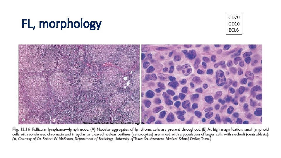 FL, morphology Elsevier. Kumar et al: Robbins Basic Pathology 10 e CD 20 CD FL, morphology Elsevier. Kumar et al: Robbins Basic Pathology 10 e CD 20 CD