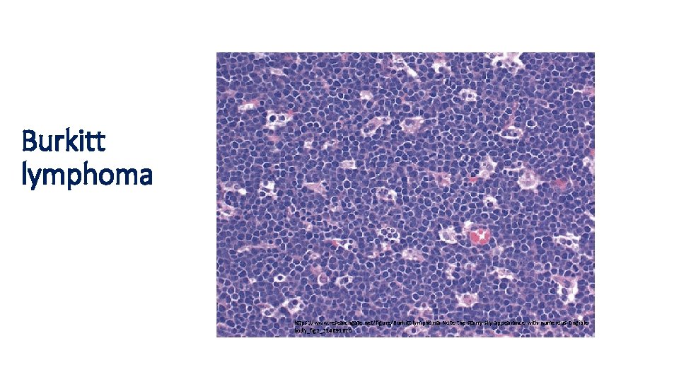 Burkitt lymphoma https: //www. researchgate. net/figure/Burkitt-lymphoma-Note-the-starry-sky-appearance-with-numerous-tingiblebody_fig 2_314691670 Burkitt lymphoma https: //www. researchgate. net/figure/Burkitt-lymphoma-Note-the-starry-sky-appearance-with-numerous-tingiblebody_fig 2_314691670
