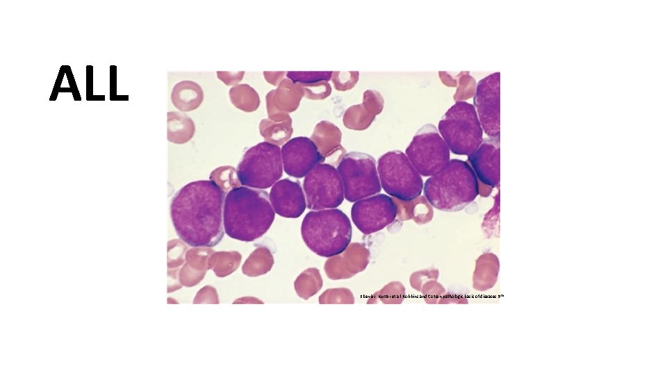 ALL Elsevier. Kumar et al. Robbins and Cotran pathologic basis of diseases 9 th ALL Elsevier. Kumar et al. Robbins and Cotran pathologic basis of diseases 9 th