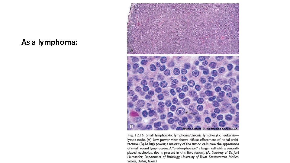 As a lymphoma: Elsevier. Kumar et al: Robbins Basic Pathology 10 e As a lymphoma: Elsevier. Kumar et al: Robbins Basic Pathology 10 e