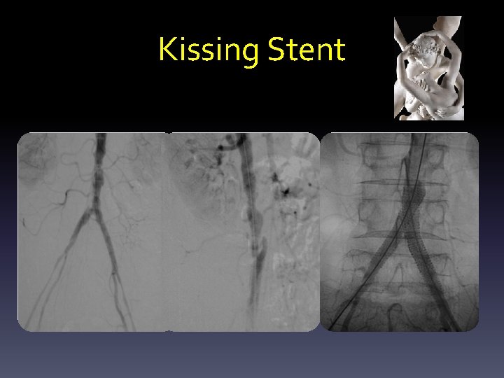 Kissing Stent 