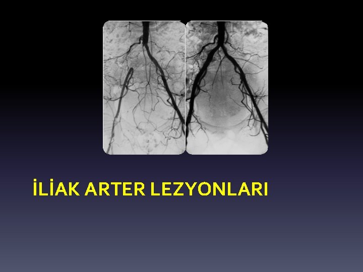 İLİAK ARTER LEZYONLARI İLİAK ARTER LEZYONLARI