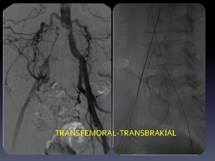 TRANSFEMORAL-TRANSBRAKİAL 