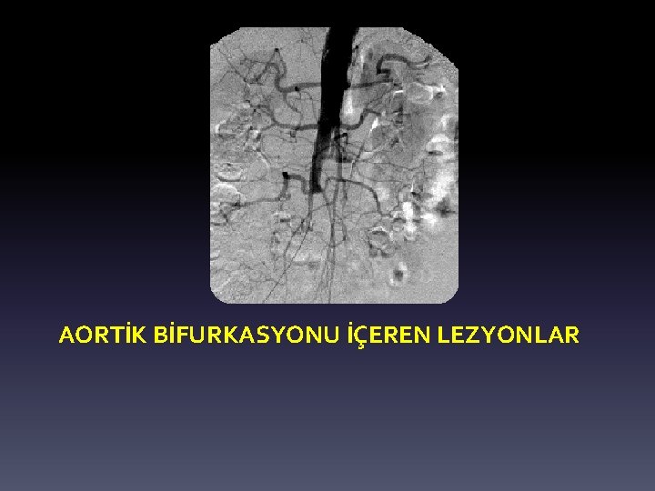 AORTİK BİFURKASYONU İÇEREN LEZYONLAR 