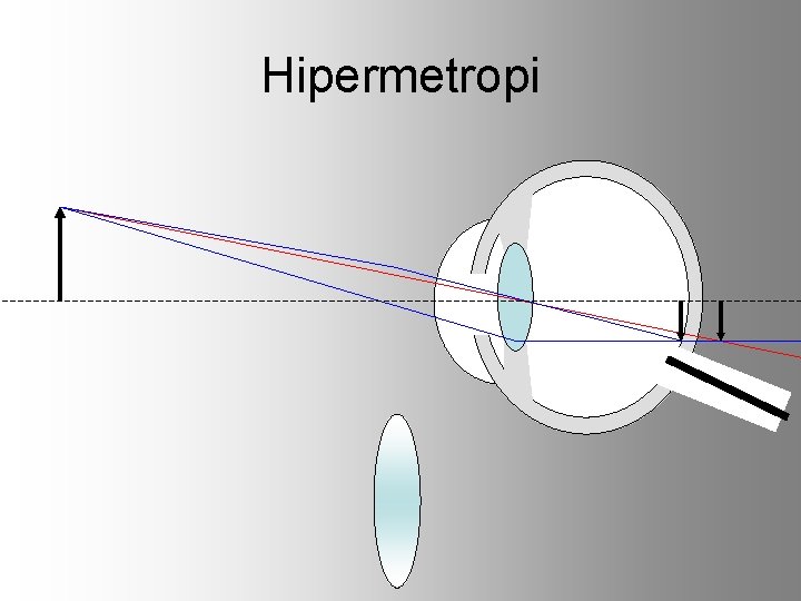 Hipermetropi 