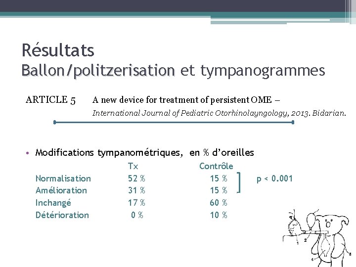 Résultats Ballon/politzerisation et tympanogrammes ARTICLE 5 A new device for treatment of persistent OME