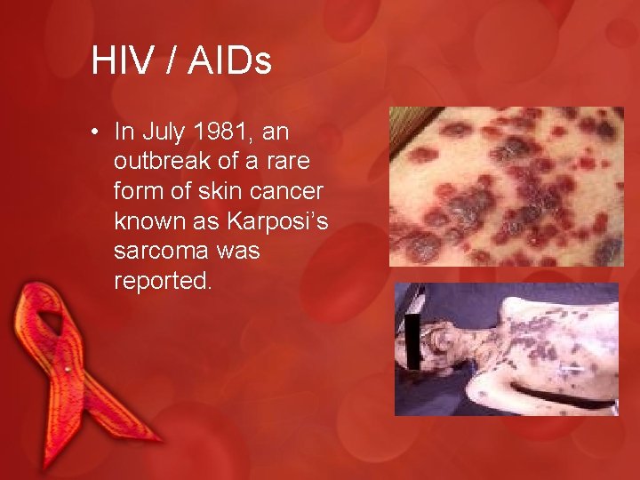 HIV / AIDs • In July 1981, an outbreak of a rare form of