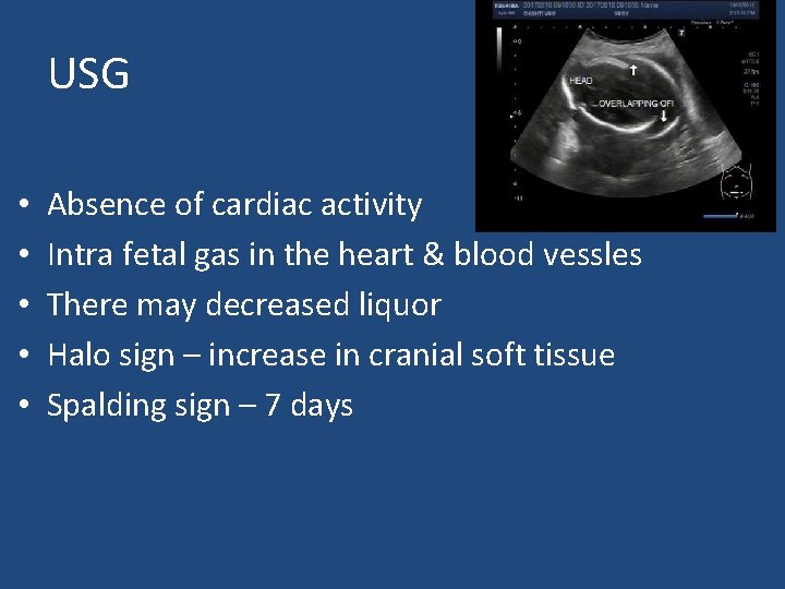 USG • • • Absence of cardiac activity Intra fetal gas in the heart