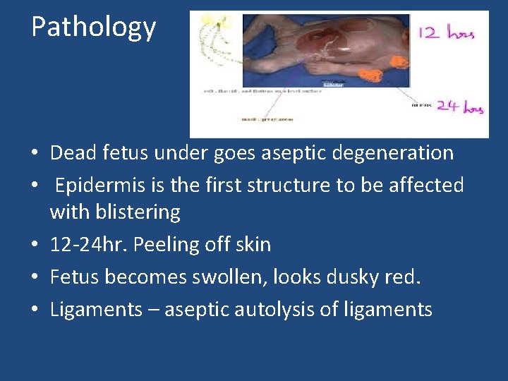 Pathology • Dead fetus under goes aseptic degeneration • Epidermis is the first structure