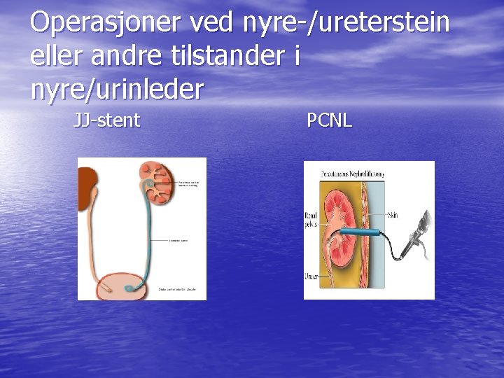 Operasjoner ved nyre-/ureterstein eller andre tilstander i nyre/urinleder JJ-stent PCNL Operasjoner ved nyre-/ureterstein eller andre tilstander i nyre/urinleder JJ-stent PCNL
