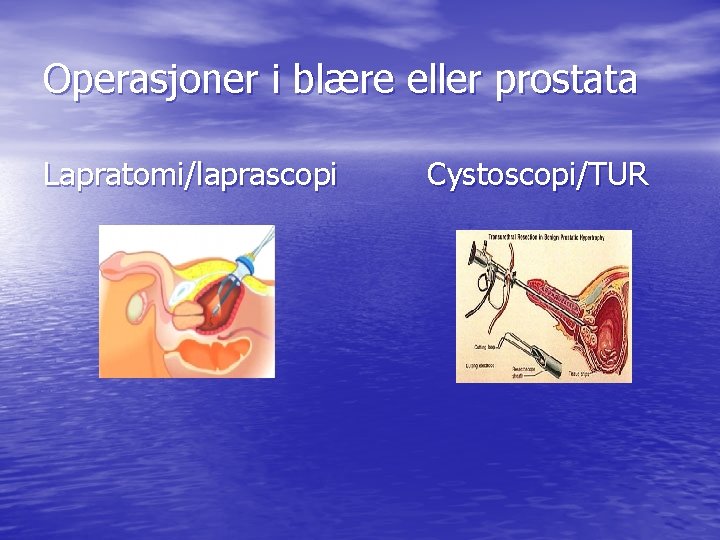Operasjoner i blære eller prostata Lapratomi/laprascopi Cystoscopi/TUR Operasjoner i blære eller prostata Lapratomi/laprascopi Cystoscopi/TUR