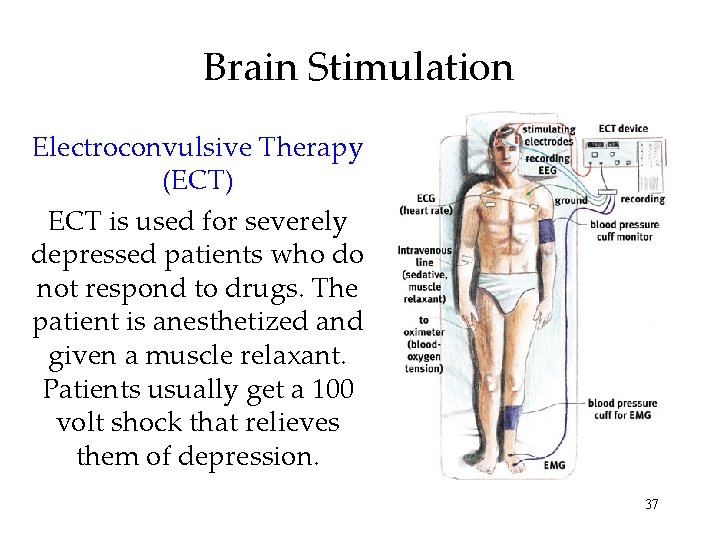 Brain Stimulation Electroconvulsive Therapy (ECT) ECT is used for severely depressed patients who do