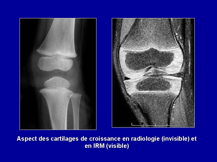 Aspect des cartilages de croissance en radiologie (invisible) et en IRM (visible) 