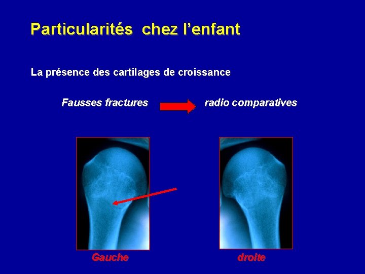 Particularités chez l’enfant La présence des cartilages de croissance Fausses fractures Gauche radio comparatives Particularités chez l’enfant La présence des cartilages de croissance Fausses fractures Gauche radio comparatives