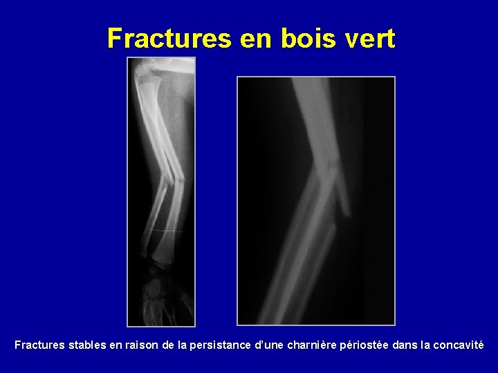 Fractures en bois vert Fractures stables en raison de la persistance d’une charnière périostée Fractures en bois vert Fractures stables en raison de la persistance d’une charnière périostée