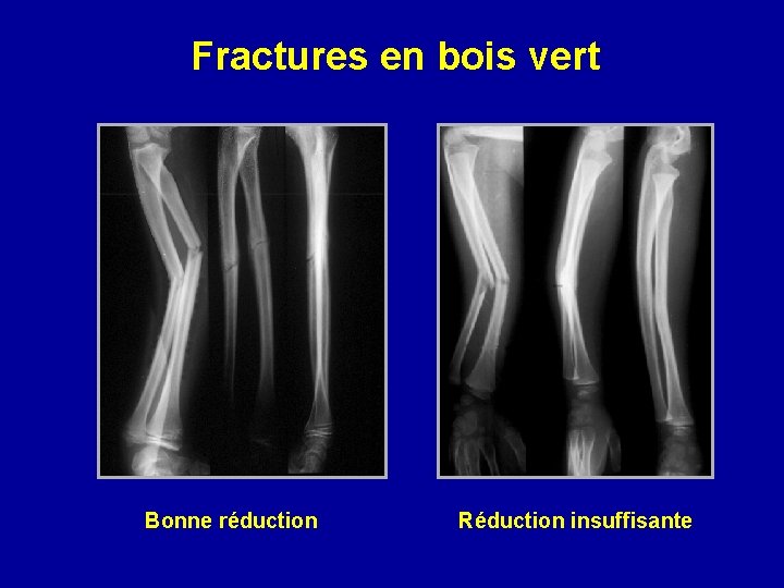 Fractures en bois vert Bonne réduction Réduction insuffisante 