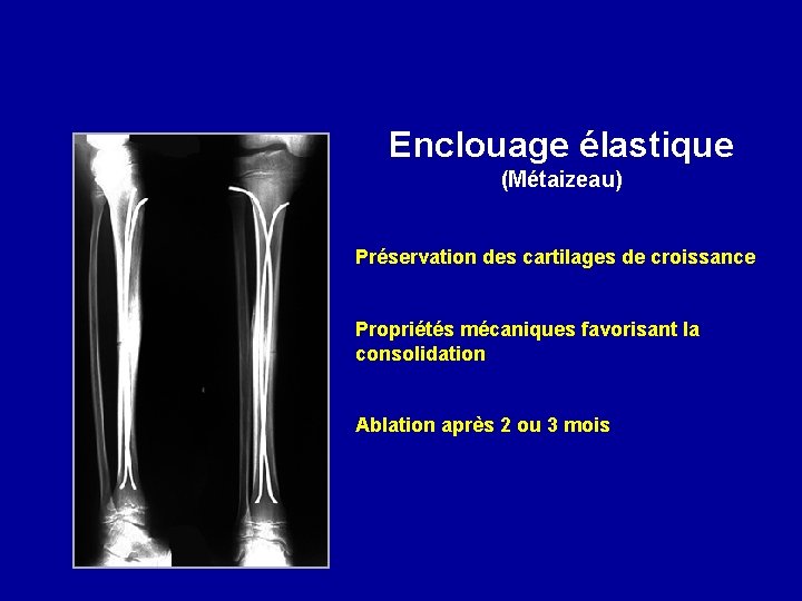 Enclouage élastique (Métaizeau) Préservation des cartilages de croissance Propriétés mécaniques favorisant la consolidation Ablation