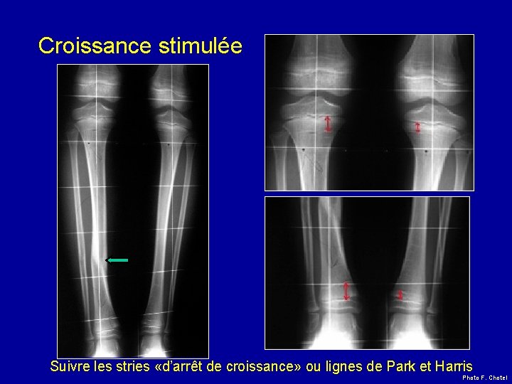 Croissance stimulée Suivre les stries «d’arrêt de croissance» ou lignes de Park et Harris