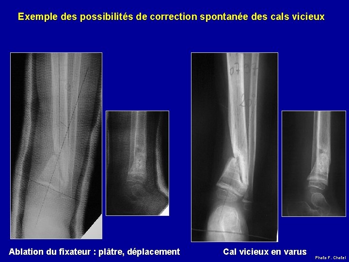 Exemple des possibilités de correction spontanée des cals vicieux Ablation du fixateur : plâtre,