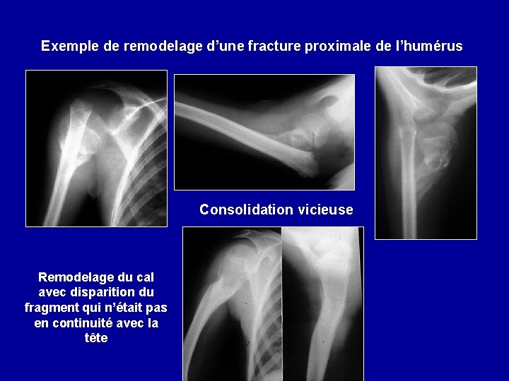 Exemple de remodelage d’une fracture proximale de l’humérus Consolidation vicieuse Remodelage du cal avec