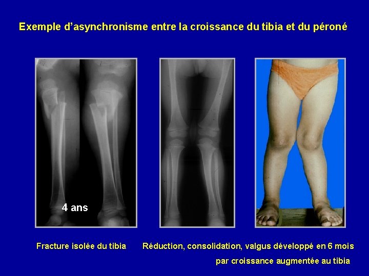 Exemple d’asynchronisme entre la croissance du tibia et du péroné 4 ans Fracture isolée