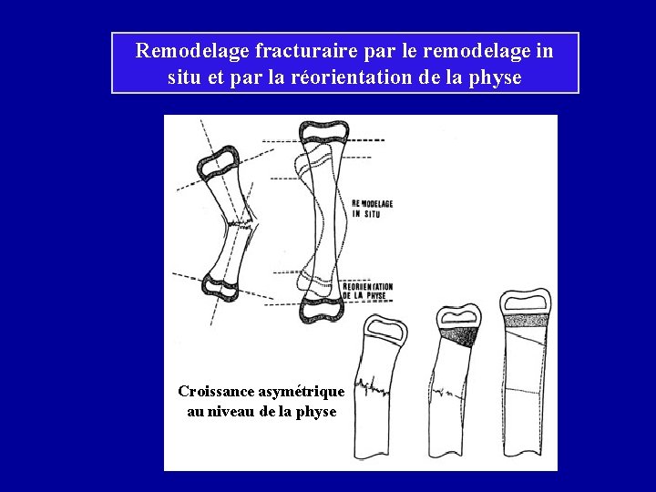 Remodelage fracturaire par le remodelage in situ et par la réorientation de la physe