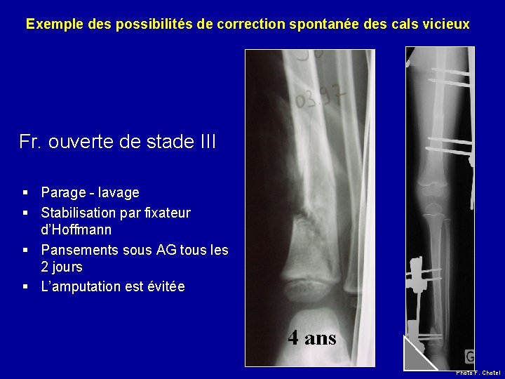 Exemple des possibilités de correction spontanée des cals vicieux Fr. ouverte de stade III