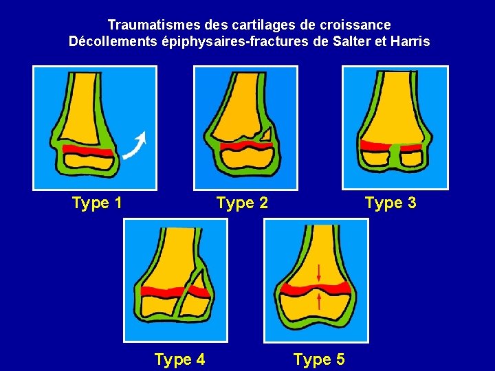 Traumatismes des cartilages de croissance Décollements épiphysaires-fractures de Salter et Harris Type 1 Type
