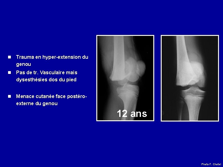 n Trauma en hyper-extension du genou n Pas de tr. Vasculaire mais dysesthésies dos